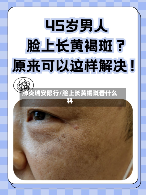 肺炎瑞安限行/脸上长黄褐斑看什么科-第1张图片