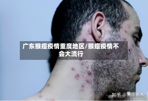 广东猴痘疫情重度地区/猴痘疫情不会大流行-第1张图片