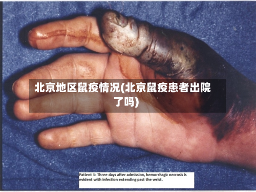 北京地区鼠疫情况(北京鼠疫患者出院了吗)